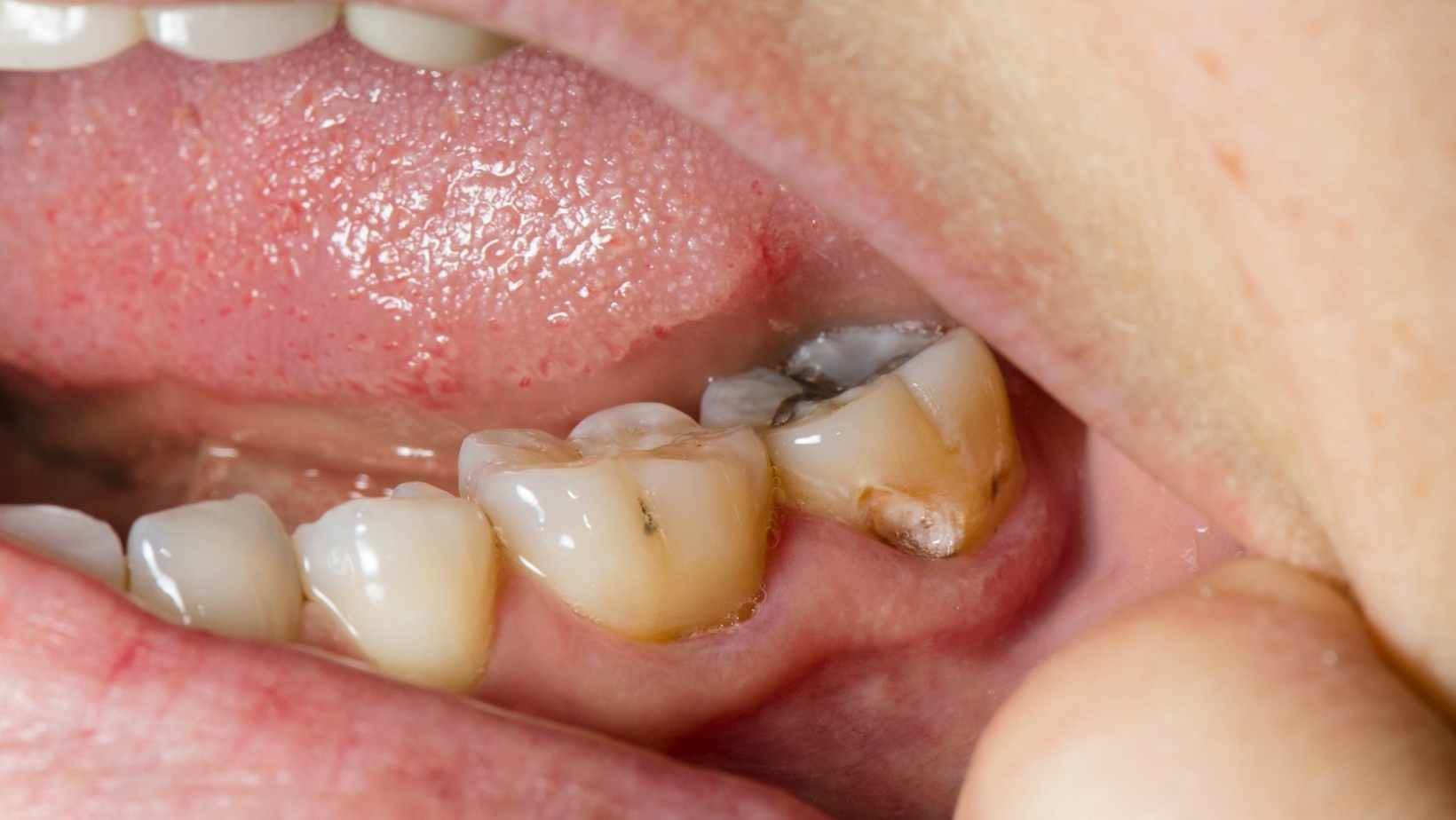 انواع روش های درمان پوسیدگی دندان