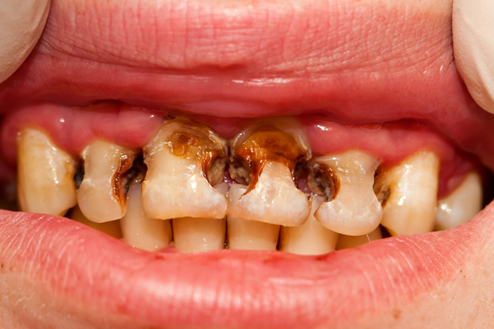 انواع پوسیدگی دندان - درمان پوسیدگی دندان