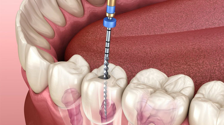 درمان کانال ریشه | تجهیزات دندانپزشکی فیروز دنتال